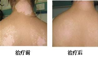 白癜风治疗好转后为什么又复发