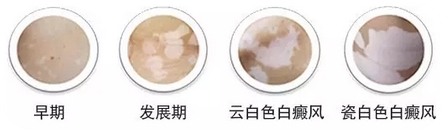 老年人身上长白斑，是老年斑还是白癜风